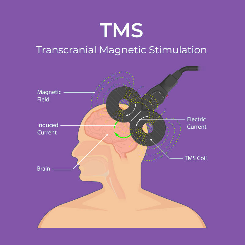 tms transcranial magnetic stimulation london tms transcranial magnetic stimulation london