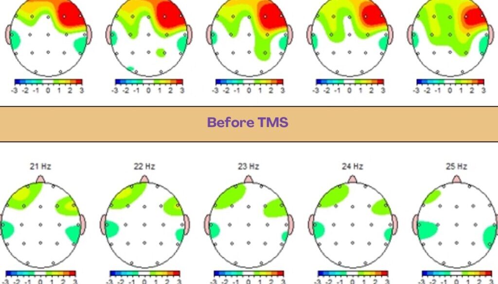 Guided TMS Treatment