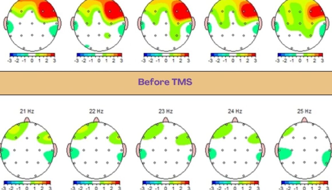 Guided TMS Treatment
