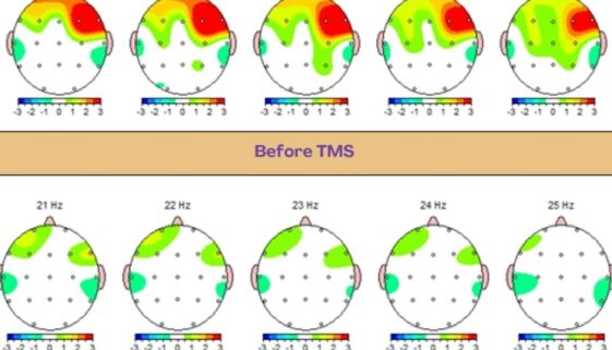 Guided TMS Treatment